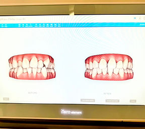 光学式口腔内スキャナー(3Dスキャニング機器)のiTero elementを導入しました。口腔内を3Dスキャンし、歯並びや噛み合わせをその場で確認して矯正後の歯並びシュミレーションが可能です。
